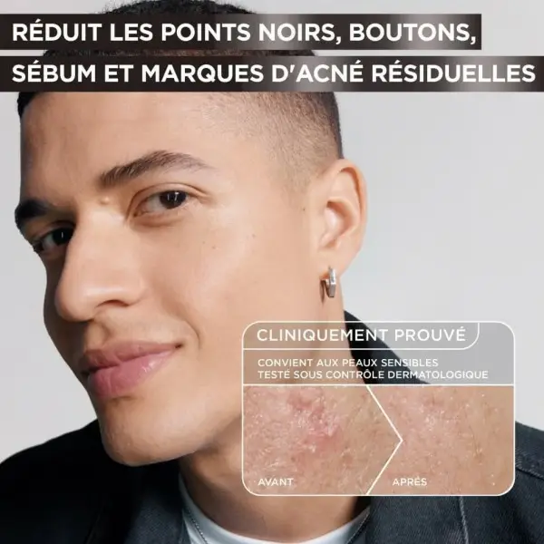 GARNIER Pure Active Serum tegen mee-eters en onzuiverheden met houtskool, niacinamide, salicylzuur en melkzuur