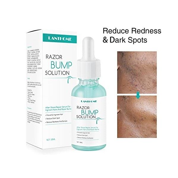 Maodom Razor Bumps Essence - 30 ML dessence pour Les Bosses du Rasoir et Les Poils incarnés | Soins de la Peau pour Le Visag