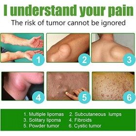 2pcs LipomaCure Soothing Ointment, LumpFree Lipoma Removal Cream,Lipoma Lumps Removal Cream