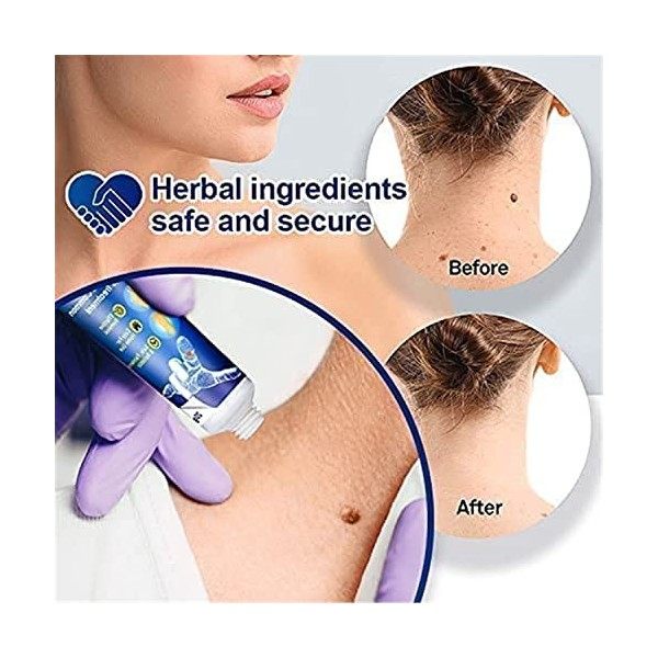 2PCS WartsOff Instant Blemish Removal Cream | Warts Off Instant Blemish Removal Cream | Wartsoff Instant Blemish Removal Gel,...