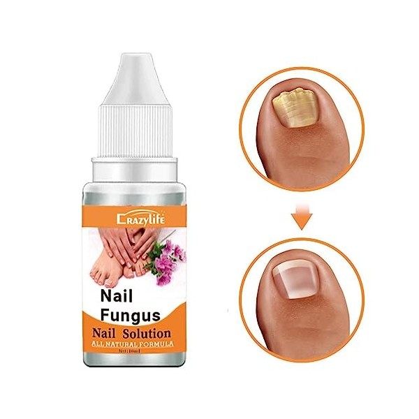 Réparation dongles fendus Solution pour ongles extra-forte - Réparation des ongles des orteils de 0,35 oz, pour les doigts e