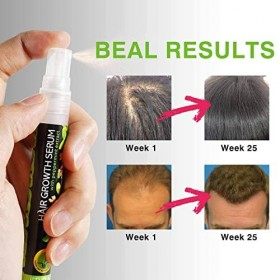 Moslate Sérum au pour la Croissance des Cheveux | Spray de sérum de Traitement de la Repousse des Cheveux | Spray maximisateu