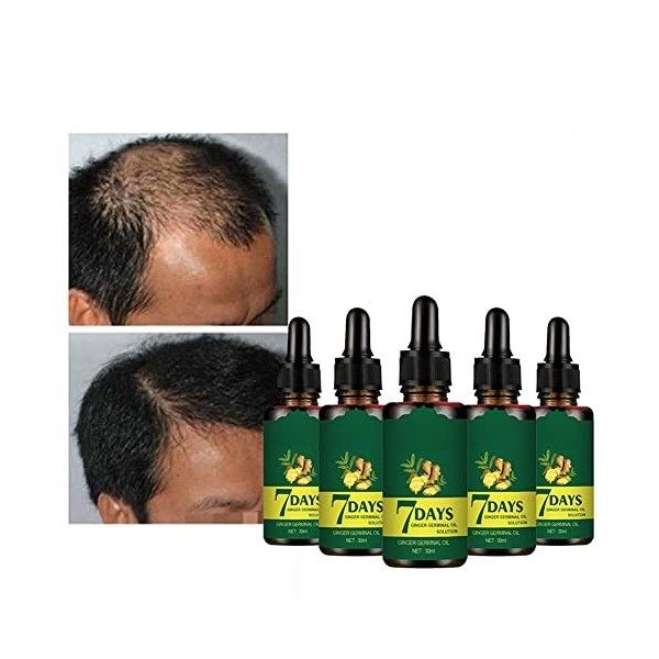 Sérum de Croissance de Cheveux, Huile Germinale de Gingembre, Anti Chute Cheveux Sérum de Cheveux,Perte de Cheveux et Cheveux