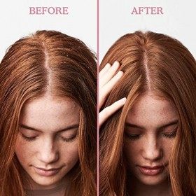 Umberto Giannini Scalp Rescue Masque anti-pelliculaire pour cheveux et cuir chevelu – Traitement pour cuir chevelu squameux e