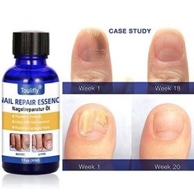 Mycose Ongles Des Pieds,Mycose Ongle,Traitement Mycose Ongle Pied,Traitement Ongles,Solution Pour Les Ongles Décolorés,Épaiss