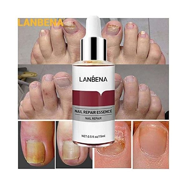 LANBENA Nail Repair Essence Serum Fungus Treatment Nail Removal Onychomycosis Toe Nail Glow Nourishing Care Hand and Feet Car