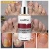 LANBENA Nail Repair Essence Serum Fungus Treatment Nail Removal Onychomycosis Toe Nail Glow Nourishing Care Hand and Feet Car