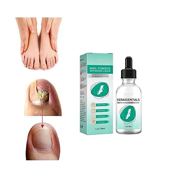 1/2/3Pcs Kerassentials for Toenail Fungus - Kerassentials Toenail Fungus Treatment Oil - Kerasentials Nail Treatment - Kerass