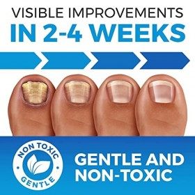 Traitement antifongique pour ongles dorteils Extra fort avec traitement des pieds dathlètes – Kit de pédicure