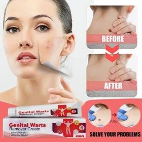 Pommade Anti-verrues Génitales 20g Supprimer les étiquettes de Peau Cors Singe Plat Vous Crème Anti-verrues Soulager Linconf