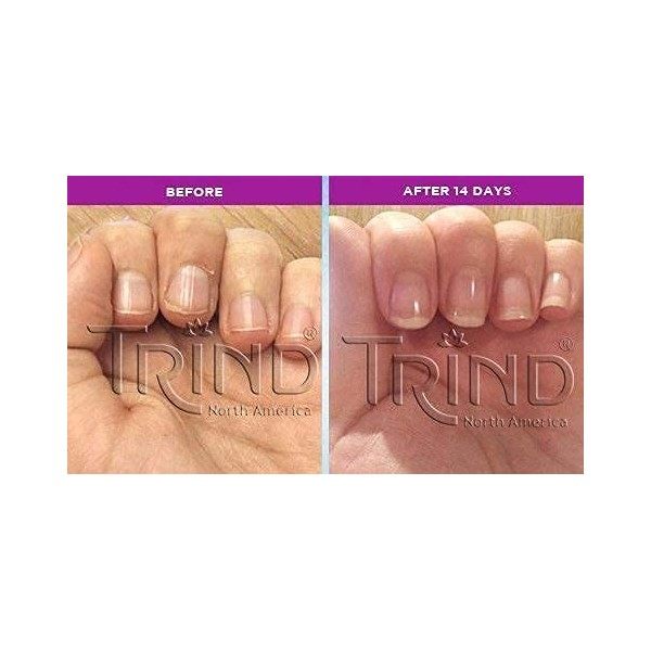 TRIND | Kit de renforcement des ongles + dissolvant | Traitement restructurant pour ongles fragiles ou écaillés | Résultats v