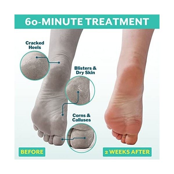 patchology PoshPeel Pedi Cure