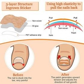 152 Ensemble Doutils pour Ongles Incarnés avec Patch élastique, pince à Ongles Courbés et Autocollant Correcteur incarné, Li