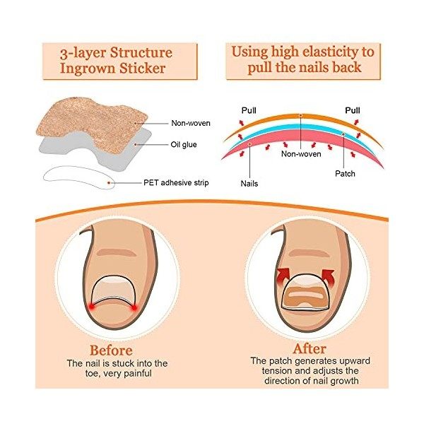 152 Ensemble Doutils pour Ongles Incarnés avec Patch élastique, pince à Ongles Courbés et Autocollant Correcteur incarné, Li