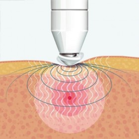 Peter Bausch 0345 Appareil de massage-acupuncture