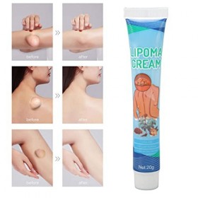 Crème de Lipome, Crème de Suppression de Lipome Soulageant linconfort 0,7 Oz pour le Kyste sébacé