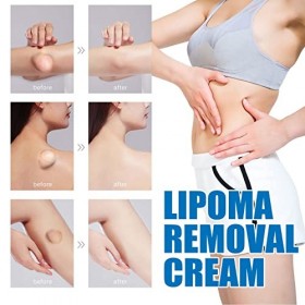 Crème de suppression de lipome, crème de soin de lipome portable soulageant linconfort léger extrait de plante pour kyste sé