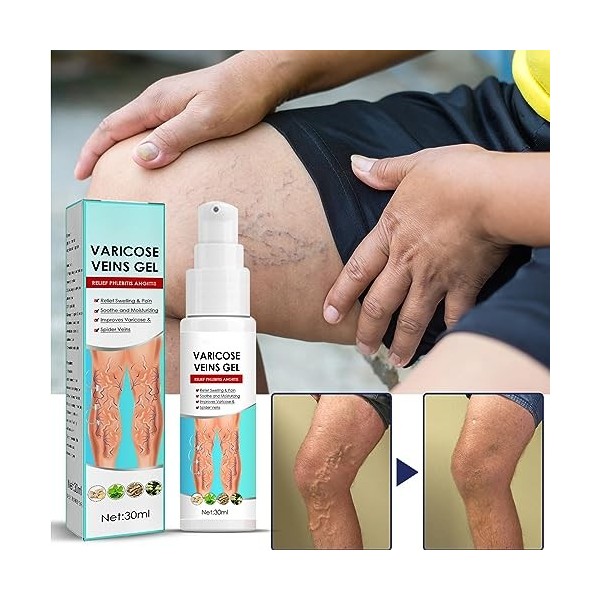 KOAHDE Gel pour Varices pour les Jambe,Varices Traitement Jambe Gel,Gels Contre les Varices,Gels pour Varices pour Veines,Crè