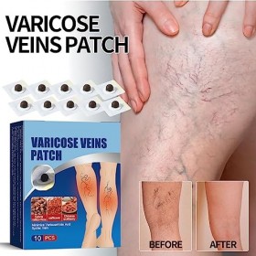 Patch de Soulagement des Varices,Anti Varices Patchs,Patch pour les Varices pour les Jambes,Patchs pour Varices,Patch Amélior