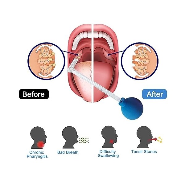 Outils Pour Enlever Les Pierres dAmygdales Pour Nettoyer La Bouche Et Nettoyer Les Amygdales Bouche Pailles De Nettoyage Pou