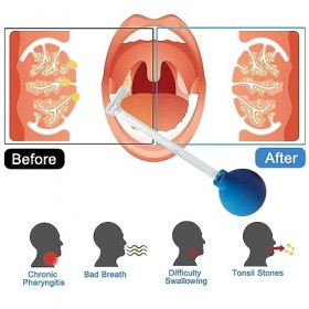 Outil Pour Enlever Les Pierres dAmygdales Nettoyer Tonsil Stone Cleaning La Bouche Amygdales Pailles De Nettoyage Pour Netto