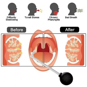 Outil Pour Enlever Les Pierres dAmygdales Nettoyer La Bouche Amygdales Pailles De Nettoyage Tonsil Stone Cleaning Pour Netto