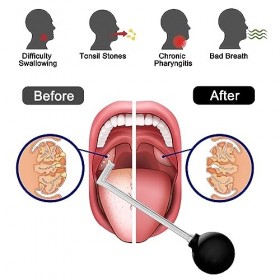 Outils Pour Enlever Les Pierres dAmygdales Nettoyer La Bouche Et Nettoyer Les Amygdales Pailles De Nettoyage Soins Bucco-Den