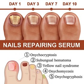 Sérum fortifiant et fortifiant pour la croissance des ongles, sérum pour les ongles abîmés et décolorés 7 jours