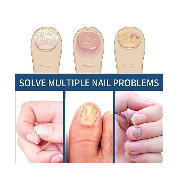 Lot de 32 patchs de traitement fongique pour ongles - Effet fongique pour orteils et ongles - Pour restaurer les ongles endom