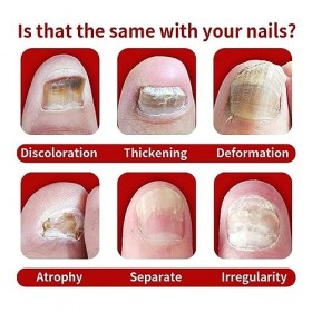 Huile donychomycose pour ongles - Huile de soulagement rapide pour ongles - Huile de soulagement rapide pour ongles - Huile 