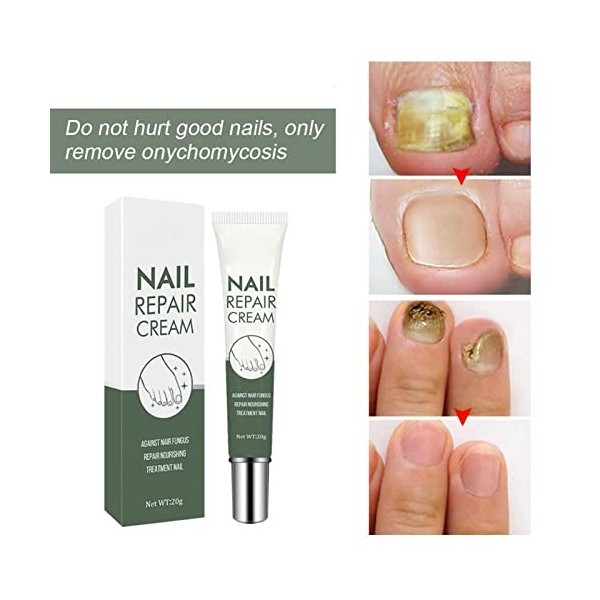 20 G Soin et Traitement des Ongles, Gel Réparateur des Ongles, Traitement des Ongles des Pieds, Répare, Répare et Protège con