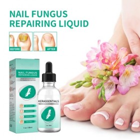 Liquide de réparation pour ongles dorteils, huile de traitement de la mycose des ongles dorteils, cassés, fissurés et décol