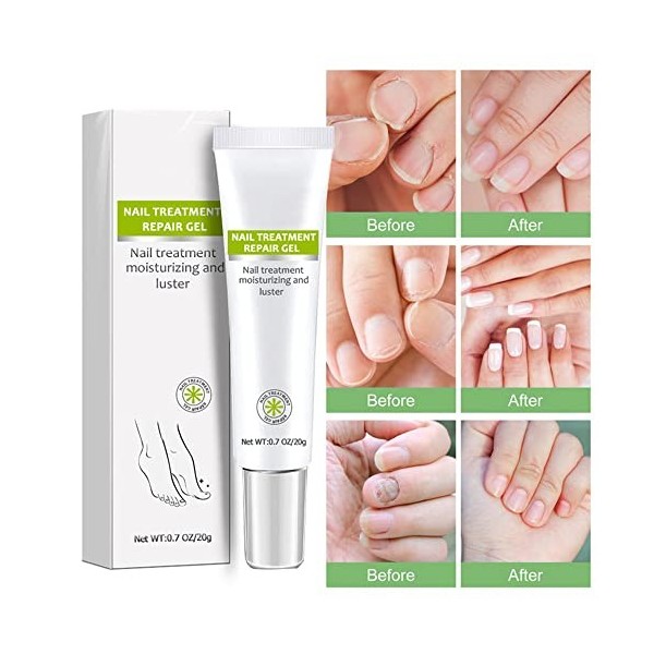 Réparation des ongles – Gel de réparation pour ongles et ongles des orteils – Crème de réparation pour ongles et ongles des o