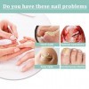 Traitement fongique pour ongles dorteils extra fort, aide à traiter les ongles incarnés,