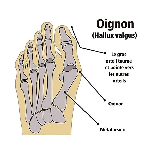 XOPOZON Hallux Valgus Correcteur, Correcteur Attelle avec Gel Coussinet pour les Soins de Santé du Pied, Correction Invisible