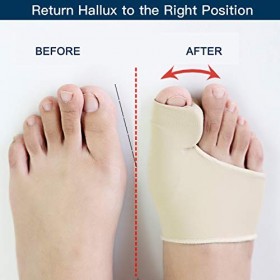 1 Paire de Orthèse Hallux Valgus avec Coussinet de Gel, Protecteur et Séparateur de Gros Orteil, Manchon Correcteur doignon 