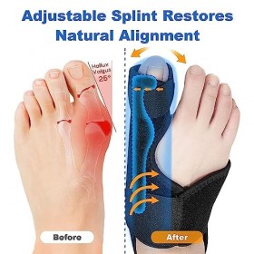 Correcteur de gros oignons, redresseur dorteils pour soulager les oignons, hallux valgus, bande élastique pour soulager la d