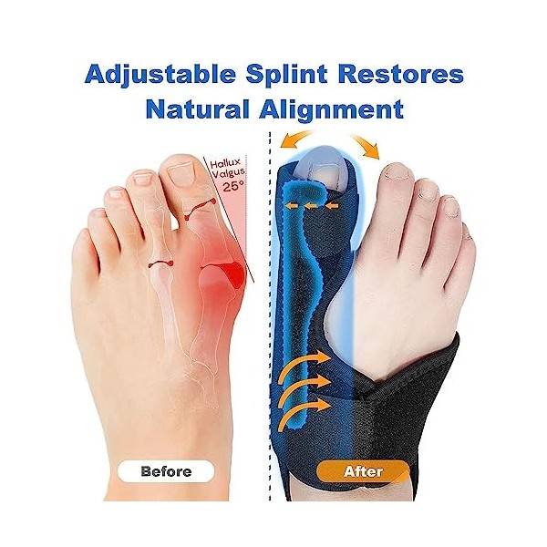 Correcteur de gros oignons, redresseur dorteils pour soulager les oignons, hallux valgus, bande élastique pour soulager la d