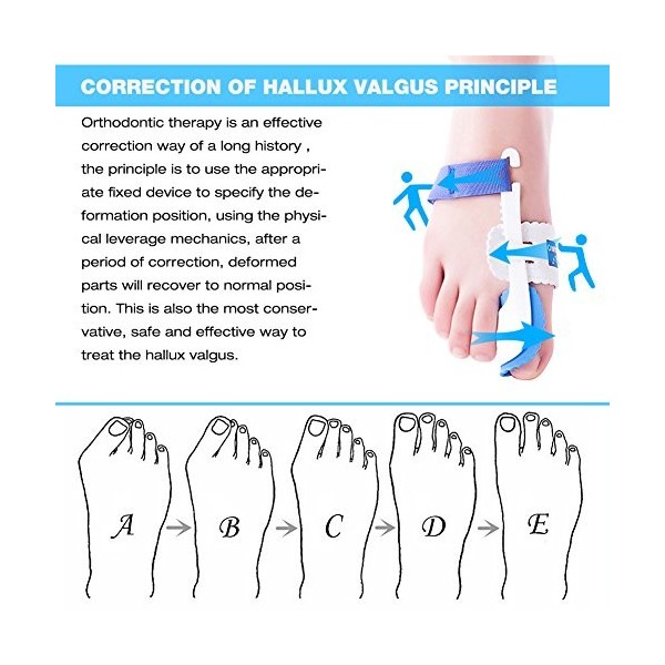 Kemei Paire de coussinets de correction avec attelle pour hallux valgus et oignon Soulagement de la douleur et correction pou