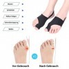 Eurtes Lot de 6 écarteurs dorteils hallux valgus - Avec protection des oignons - Correction de bunion - Bandage chaussettes 