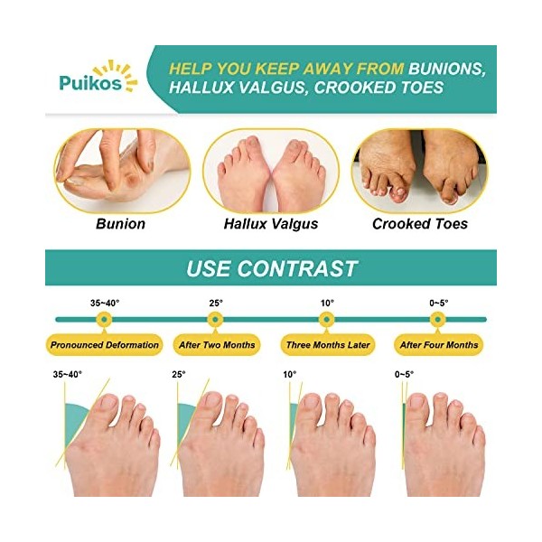 Puikos Hallux Valgus Correcteur,Hallux Valgus Attelle, Bunion Corrector pour Femmes Hommes, Orthèse Hallux Valgus, Séparateur