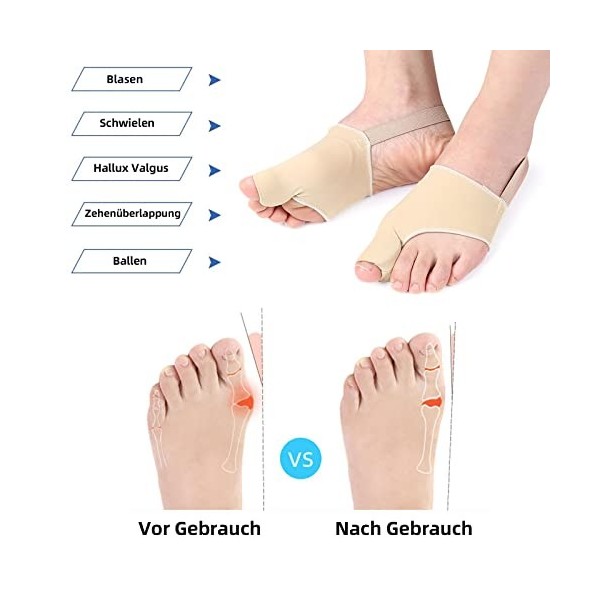 Eurtes Lot de 6 écarteurs dorteils hallux valgus - Avec protection des oignons - Correction de bunion - Bandage chaussettes 