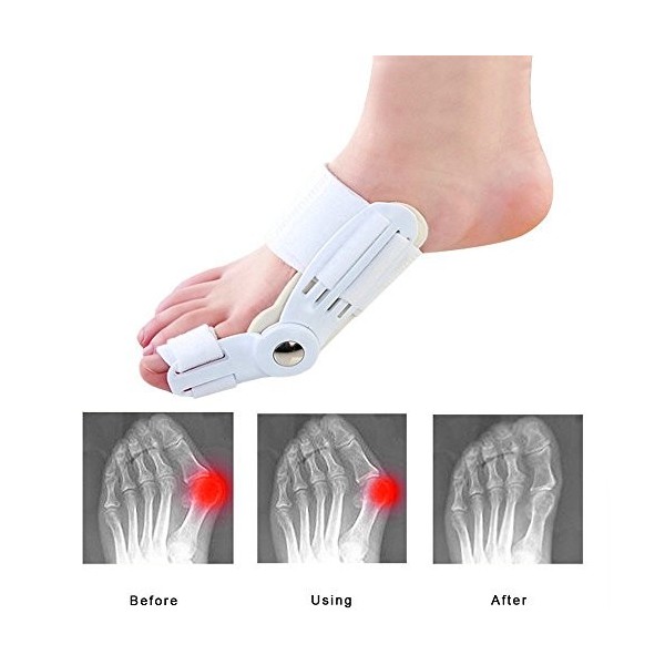 12 pcs Oignon Correcteur et Oignon Attelle Kits de Care, doux Gel séparateurs dorteils entretoises – corriger hallux valgus 