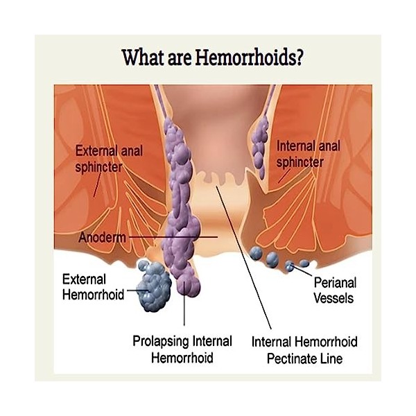 3 Boxes Natural Herbal Strength Hemorrhoid Capsules, Hemorrhoid Suppository, Rapid Hemorrhoid Treatment, Natural Hemorrhoid R