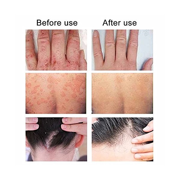 Crème De Psoriasis De La Peau Dermatite Et Eczéma Pommade Pour Leczéma Traiter Les Peaux Sèches, Démangeaisons Et Sensibles,