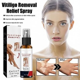 KOAHDE Spray Anti-Taches Blanches,Spray de Réparation Vitiligo,Sprays Soulagement Vitiligo,Spray Délimination du Vitiligo,Sp