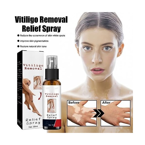 KOAHDE Spray Anti-Taches Blanches,Spray de Réparation Vitiligo,Sprays Soulagement Vitiligo,Spray Délimination du Vitiligo,Sp