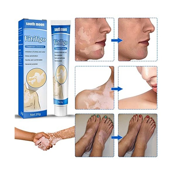 2Pcs Vitiligo Cream, Crème de Traitement du Vitiligo, Vitiligo Pommade Leukoplakia, Traitement des Taches Blanches sur la Pea