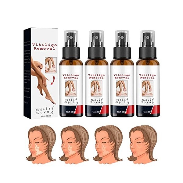 Gienslru Vitiligo Removal Relief Spray, Vitiligoremoval Relief Spray, Vitiligo Skin Repair Spray, Vitiligo Treatment Spray, R