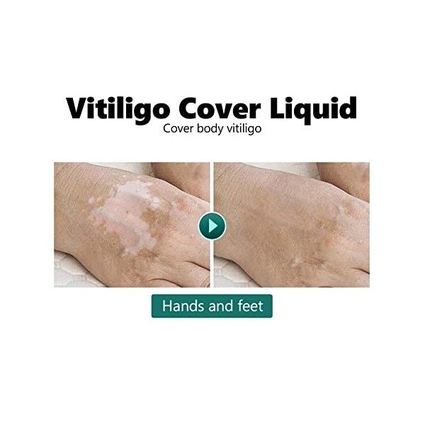 Vitiligo Cover Liquid, Vitiligo Covering Liquid Waterproof Makeup Vitiligo Concealer Cosmetics For Face Body 20ml